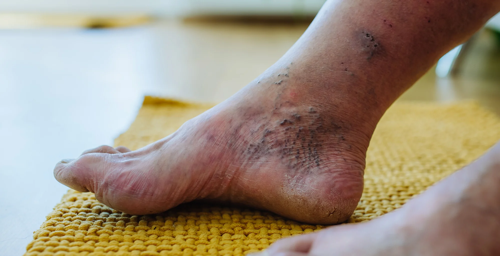 Dr. MD. Sabir Pasha - Diabetic Foot & Wound Management Specialist